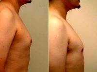 24 Year Old Male With Enlarged Gynecomastia Breast Tissue With Dr. Franklin D. Richards, MD, Bethesda Plastic Surgeon