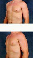 24 Year Old Man Treated With Male Breast Reduction By Doctor James F. Boynton, MD, FACS, Houston Plastic Surgeon