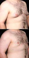 24 Year Old Man Treated With Male Breast Reduction By Doctor Michael R. Lee, MD, Dallas Plastic Surgeon