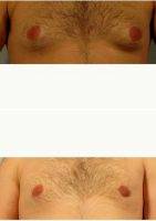 24 Year Old Man Treated With Male Breast Reduction By Dr Richard A. D'Amico, MD, FACS, Englewood Plastic Surgeon