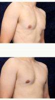 24 Year Old Man Treated With Male Breast Reduction By Dr. Douglas L. Gervais, MD, Minneapolis Plastic Surgeon8