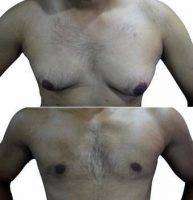24 Year Old Man Treated With Male Breast Reduction With Dr Rajat Gupta, MD, India Plastic Surgeon