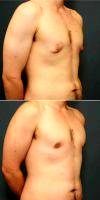 25-34 Year Old Man Requesting Male Breast Reduction With Doctor Owen Reid, MD, Richmond Plastic Surgeon