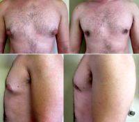 25-34 Year Old Man Treated With Male Breast Reduction By Doctor Adrian Lo, MD, Philadelphia Plastic Surgeon
