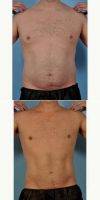25-34 Year Old Man Treated With Male Breast Reduction By Doctor Christopher D. Knotts, MD, FACS, Reston Plastic Surgeon