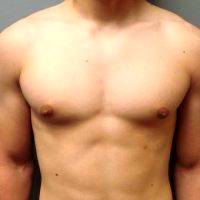 25-34 Year Old Man Treated With Male Breast Reduction By Doctor Kahlil Andrews, MD, Cedar Rapids Plastic Surgeon
