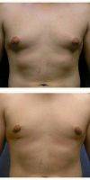 25-34 Year Old Man Treated With Male Breast Reduction By Doctor Levi J. Young, MD, Overland Park Plastic Surgeon