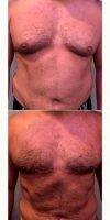 25-34 Year Old Man Treated With Male Breast Reduction By Doctor S. Larry Schlesinger, MD, FACS, Honolulu Plastic Surgeon