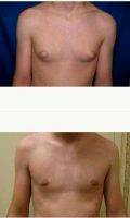 25-34 Year Old Man Treated With Male Breast Reduction By Doctor William L. Reno, III, MD, Hattiesburg Plastic Surgeon