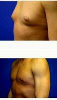 25-34 Year Old Man Treated With Male Breast Reduction By Dr Laura Randolph, MD, Bloomington Plastic Surgeon