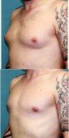 25-34 Year Old Man Treated With Male Breast Reduction By Dr Lisa Taylor, MD, Oklahoma City Plastic Surgeon