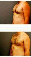 25-34 Year Old Man Treated With Male Breast Reduction By Dr Michael Marion, MD, Sandy Plastic Surgeon