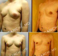 25-34 Year Old Man Treated With Male Breast Reduction By Dr Pedy Ganchi, MD, Ridgewood Plastic Surgeon