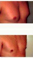 25-34 Year Old Man Treated With Male Breast Reduction By Dr. Franklin D. Richards, MD, Bethesda Plastic Surgeon