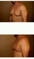 25-34 Year Old Man Treated With Male Breast Reduction By Dr. Gregory Turowski, MD, PhD, FACS, Chicago Plastic Surgeon