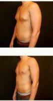 25-34 Year Old Man Treated With Male Breast Reduction By Dr. Jeffrey D. Wagner, MD, Indianapolis Plastic Surgeon
