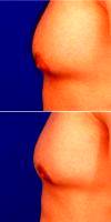 25-34 Year Old Man Treated With Male Breast Reduction By Dr. Robert Caridi, MD, Austin Plastic Surgeon