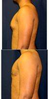 25-34 Year Old Man Treated With Male Breast Reduction By Dr. Theodore Nyame, MD, Charlotte Physician