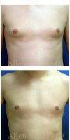 25-34 Year Old Man Treated With Male Breast Reduction Gynecomastia Surgery - Pre- 7 Months Post-op With Dr. Allen Rezai, MD, London Plastic Surgeon