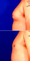 25-34 Year Old Man Treated With Male Breast Reduction - Gynecomastia Treatment With Doctor Robert Caridi, MD, Austin Plastic Surgeon
