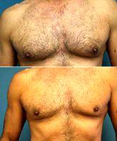 25-34 Year Old Man Treated With Male Breast Reduction With Doctor Arthur G. Handal, MD, FACS, Boca Raton Plastic Surgeon