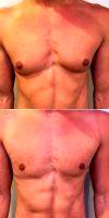 25-34 Year Old Man Treated With Male Breast Reduction With Doctor S. Larry Schlesinger, MD, FACS, Honolulu Plastic Surgeon