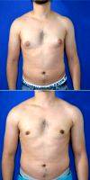 25-34 Year Old Man Treated With Male Breast Reduction With Doctor Tal T. Roudner, MD, FACS, Miami Plastic Surgeon