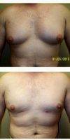 25-34 Year Old Man Treated With Male Breast Reduction With Dr Jeanette Padgett, MD, FACS, Oklahoma City Plastic Surgeon