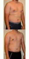 25-34 Year Old Man Treated With Male Breast Reduction With Dr M. Mark Mofid, MD, La Jolla Plastic Surgeon