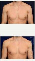 25-34 Year Old Man Treated With Male Breast Reduction With Dr Michael Law, MD, Raleigh-Durham Plastic Surgeon