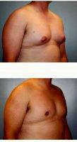 25-34 Year Old Man Treated With Male Breast Reduction With Dr. Brian K. Reedy, MD, Reading Plastic Surgeon
