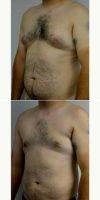 25-34 Year Old Man Treated With Male Breast Reduction With Dr. Jonathan Hall, MD, Boston Plastic Surgeon