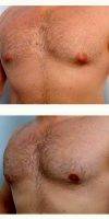 25-34 Year Old Man Treated With Male Breast Reduction With Dr. Paul Vitenas, Jr., MD, Houston Plastic Surgeon