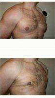 25-34 Year Old Man Treated With Male Breast Reduction With Dr. Tim Neavin, MD, Beverly Hills Plastic Surgeon