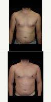 25-34 Year Old Man Treated With Male Breast Reduction (gynecomastia) By Dr Ron Hazani, MD, FACS, Beverly Hills General Surgeon