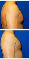 25-34 Year Old Treated With Male Breast Reduction With Dr John Nguyen, MD, FACS, Houston Plastic Surgeon