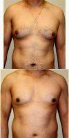 25 Year Old Male Breast Reduction With Doctor Bryan C. McIntosh, MD, Bellevue Plastic Surgeon
