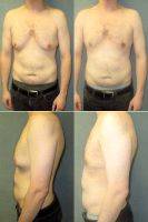 25 Year Old Male With Severe Gynecomastia After Weight Loss By Dr. Mordcai Blau, MD, New York Plastic Surgeon