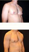 25 Year Old Man Treated With Male Breast Reduction By Doctor Jeff T. Healy, MD, Honolulu Plastic Surgeon