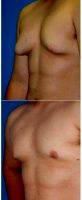 25 Year Old Man Treated With Male Breast Reduction By Dr. Dean L. Johnston, MD, Orlando Plastic Surgeon