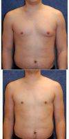 25 Year Old Man Treated With Male Breast Reduction With Dr James A. Hoffman, MD, Saint Paul Plastic Surgeon