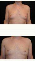25 Year Old Man Treated With Male Breast Reduction With Dr. Larry Pollack, MD, San Diego Plastic Surgeon