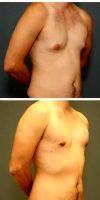 26 Year Old Man Requesting Excision Of Gynecomastia With Dr. Owen Reid, MD, Richmond Plastic Surgeon