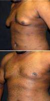 26 Year Old Man Treated With Male Breast Reduction By Dr Jeffrey D. Wagner, MD, Indianapolis Plastic Surgeon