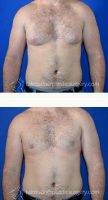 26 Year Old Man Treated With Male Breast Reduction By Dr. Tal T. Roudner, MD, FACS, Miami Plastic Surgeon