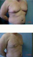 26 Year Old Man Treated With Male Breast Reduction With Dr Anne Taylor, MD, Columbus Plastic Surgeon