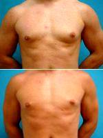 26 Year Old Man With Gynecomastia By Dr. David J. Levens, MD, Coral Springs Plastic Surgeon