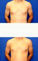 26 Year Old Man With Gynecomastia Treated With Male Breast Reduction By Dr. Daniel Brown, MD, FACS, La Jolla Plastic Surgeon