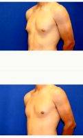 26 Year Old Man With Gynecomastia Treated With Men's Moobs Reduction By Dr. Daniel Brown, MD, FACS, La Jolla Plastic Surgeon