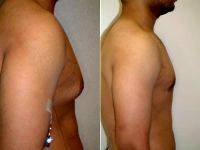 27 Year Old Male With Gynecomastia (enlarged Breasts) By Dr. Franklin D. Richards, MD, Bethesda Plastic Surgeon